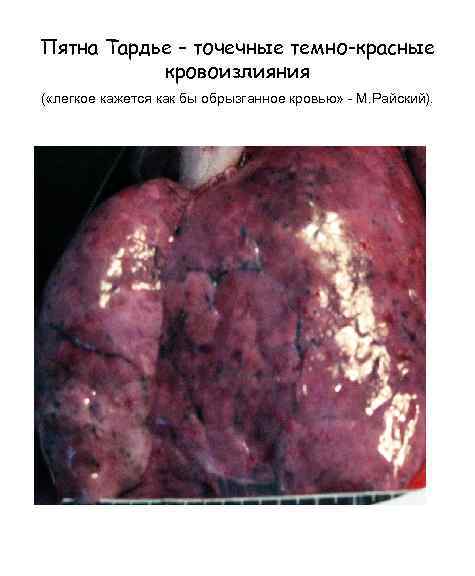 Пятна Тардье – точечные темно-красные кровоизлияния ( «легкое кажется как бы обрызганное кровью» -