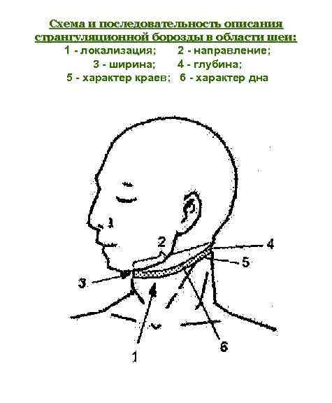 Схема и последовательность описания странгуляционной борозды в области шеи: 1 - локализация; 2 -