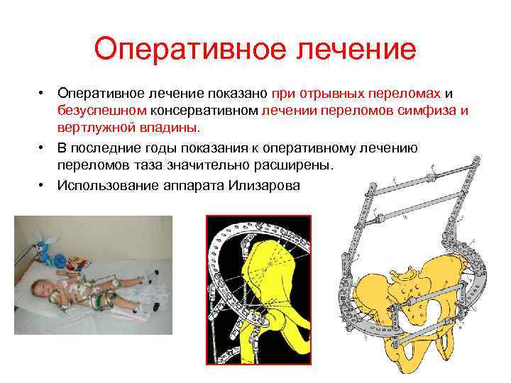Оперативное лечение • Оперативное лечение показано при отрывных переломах и безуспешном консервативном лечении переломов