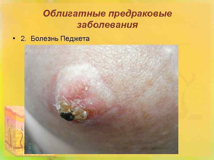 Облигатные предраковые заболевания • 2. Болезнь Педжета 