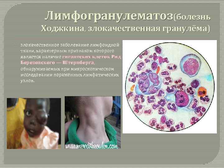 Лимфогранулематоз(болезнь Ходжкина, злокачественная гранулёма) злокачественное заболевание лимфоидной ткани, характерным признаком которого является наличие гигантских