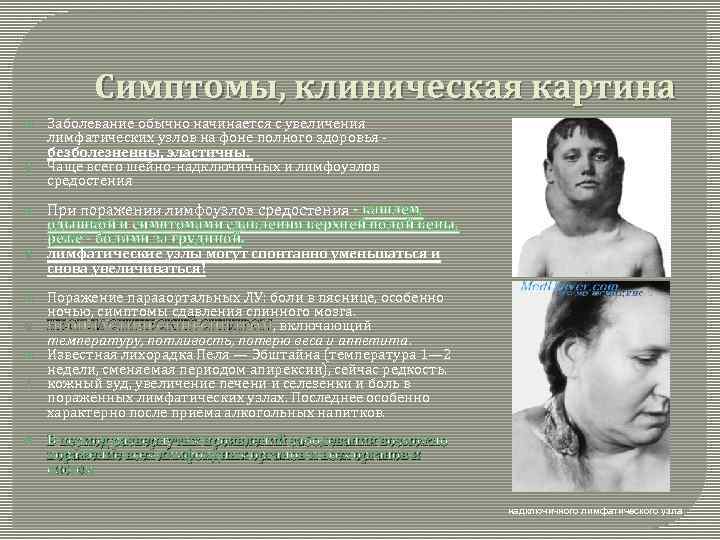 Симптомы, клиническая картина Заболевание обычно начинается с увеличения лимфатических узлов на фоне полного здоровья