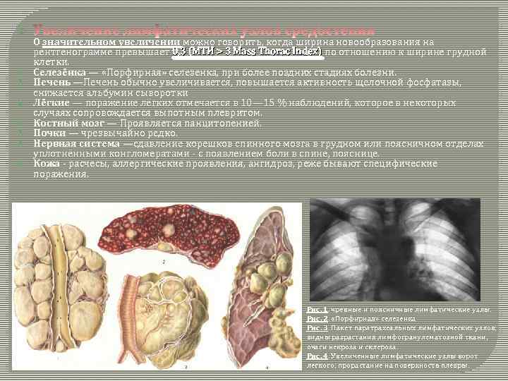  О значительном увеличении можно говорить, когда ширина новообразования на рентгенограмме превышает 0, 3