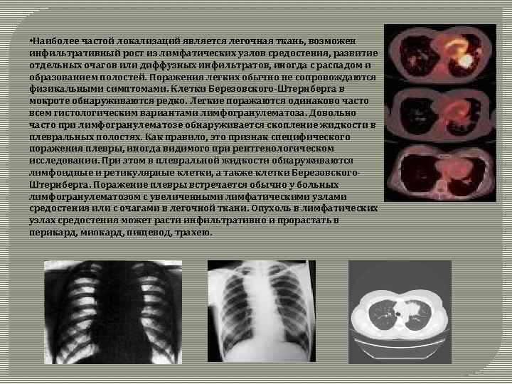  • Наиболее частой локализаций является легочная ткань, возможен инфильтративный рост из лимфатических узлов