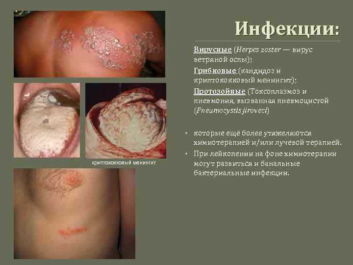 Инфекции: Вирусные (Herpes zoster — вирус Вирусные ветряной оспы); Грибковые (кандидоз и Грибковые криптококковый
