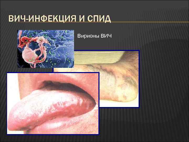 ВИЧ-ИНФЕКЦИЯ И СПИД Вирионы ВИЧ 