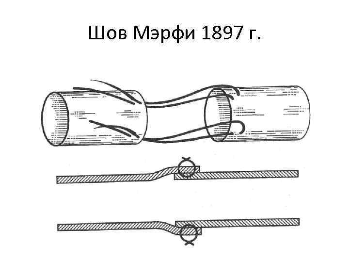 Шов Мэрфи 1897 г. 