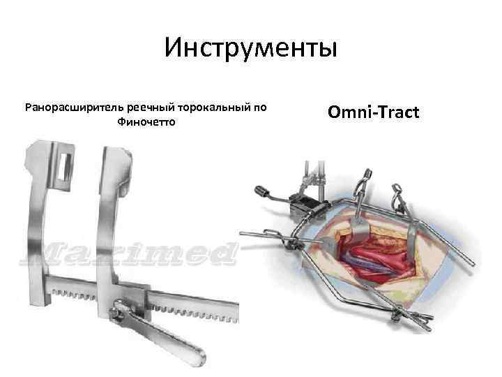 Инструменты Ранорасширитель реечный торокальный по Финочетто Omni-Tract 