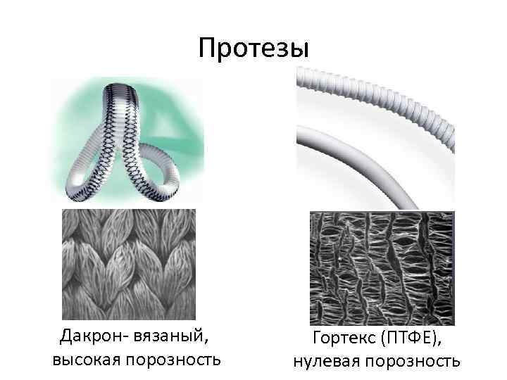 Протезы Дакрон- вязаный, высокая порозность Гортекс (ПТФЕ), нулевая порозность 