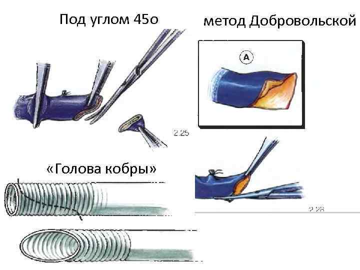Под углом 45 о «Голова кобры» метод Добровольской 