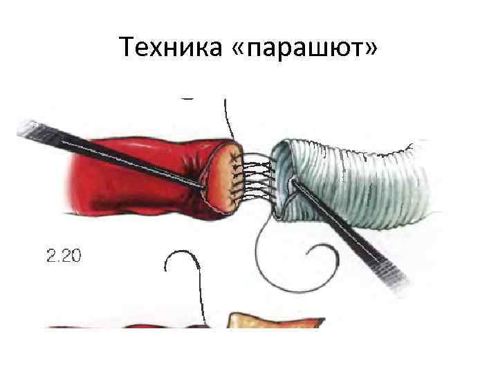 Техника «парашют» 