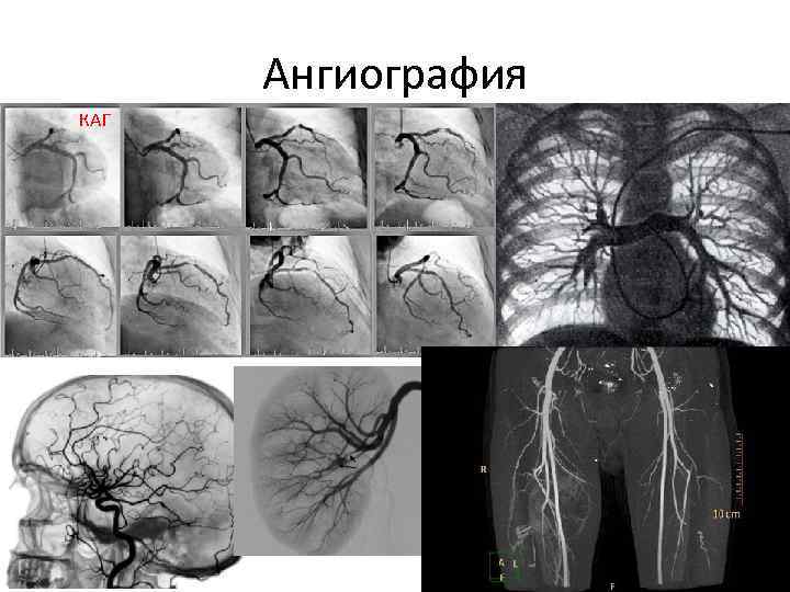 Ангиография КАГ 