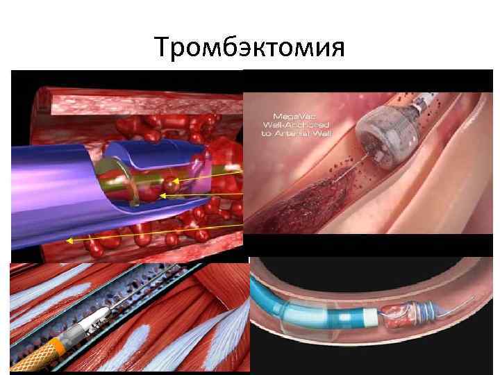Тромбэктомия 