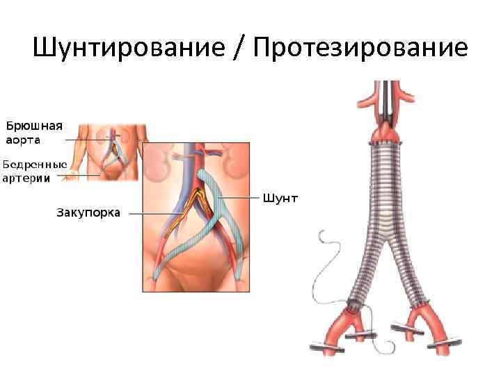 Шунтирование / Протезирование 