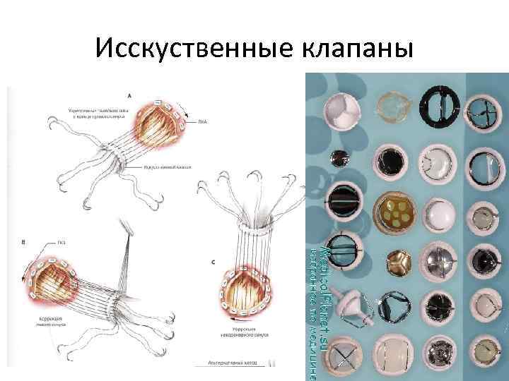 Исскуственные клапаны 
