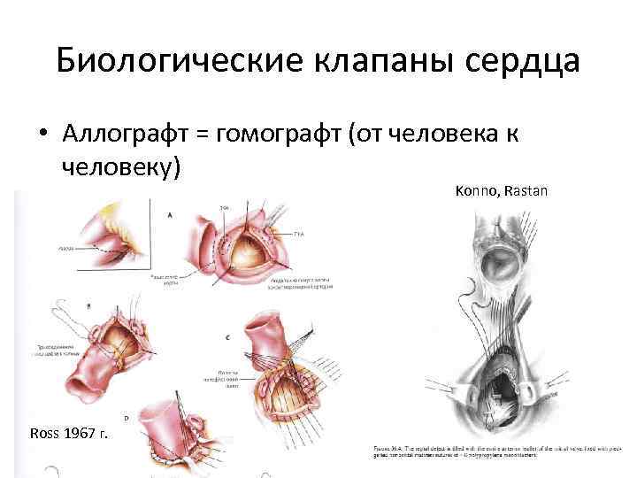 Биологические клапаны сердца • Аллографт = гомографт (от человека к человеку) Konno, Rastan Ross