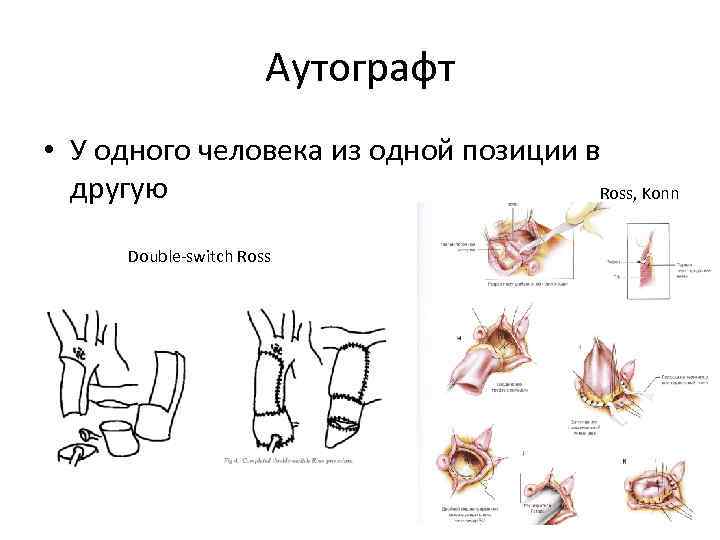 Аутографт • У одного человека из одной позиции в другую Ross, Konn Double-switch Ross