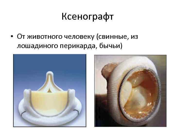 Ксенографт • От животного человеку (свинные, из лошадиного перикарда, бычьи) 