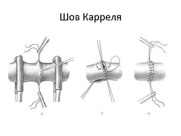 Шов Карреля 