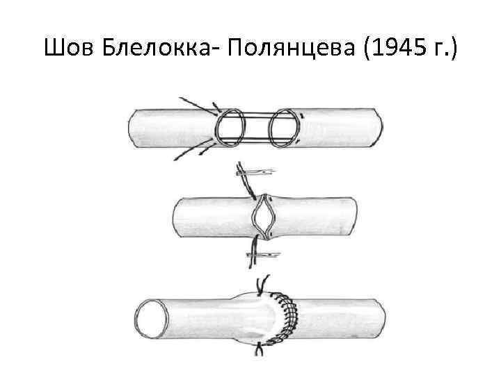 Шов Блелокка- Полянцева (1945 г. ) 