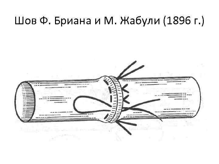 Шов Ф. Бриана и М. Жабули (1896 г. ) 