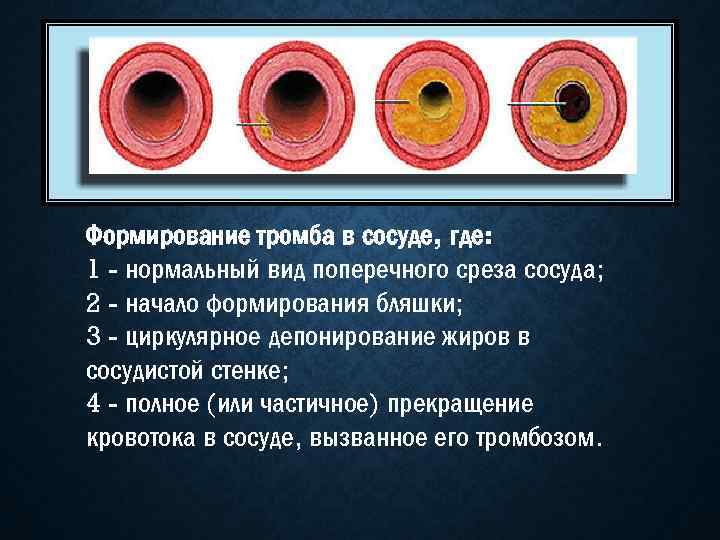 Формирование тромба в сосуде, где: 1 - нормальный вид поперечного среза сосуда; 2 -