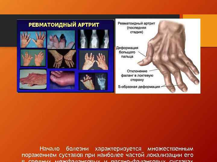 Начало болезни характеризуется множественным поражением суставов при наиболее частой локализации его 