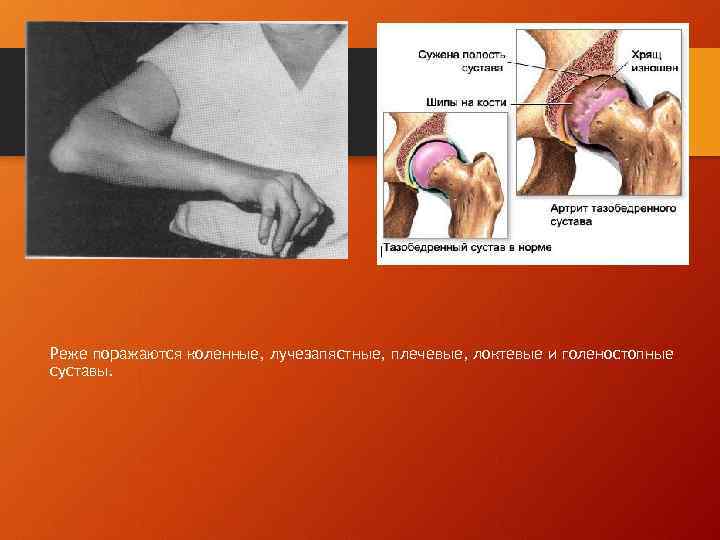Реже поражаются коленные, лучезапястные, плечевые, локтевые и голеностопные суставы. 