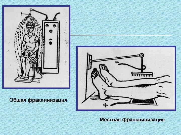 Обшая фраклинизация Местная франклинизация 