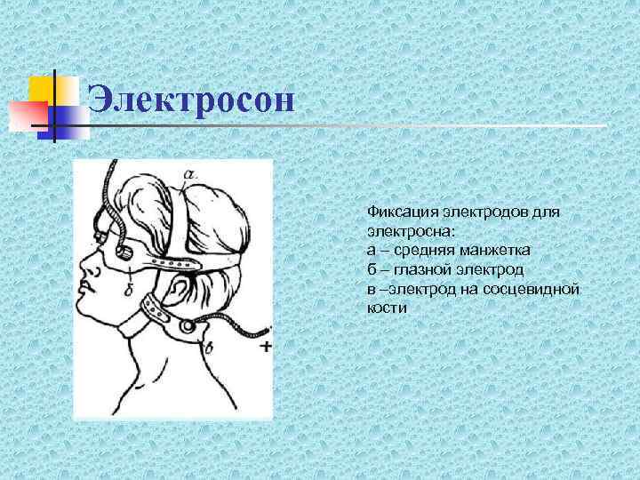 Электросон Фиксация электродов для электросна: а – средняя манжетка б – глазной электрод в