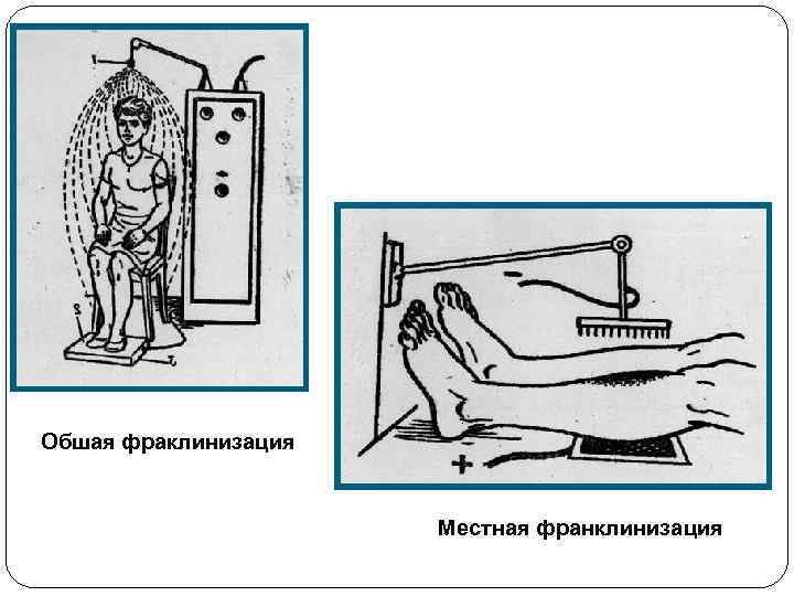 Обшая фраклинизация Местная франклинизация 