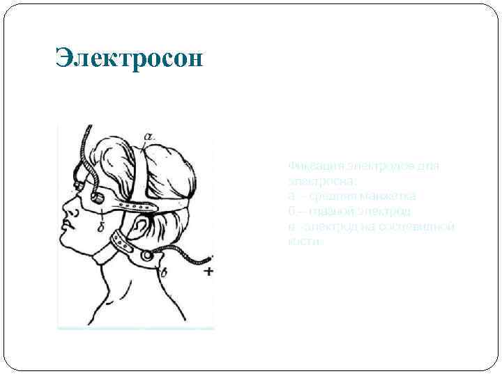 Электросон Фиксация электродов для электросна: а – средняя манжетка б – глазной электрод в