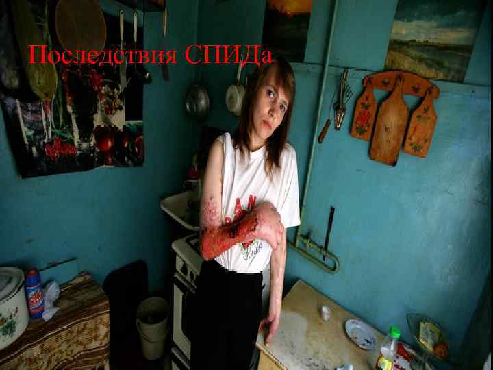 Последствия СПИДа 