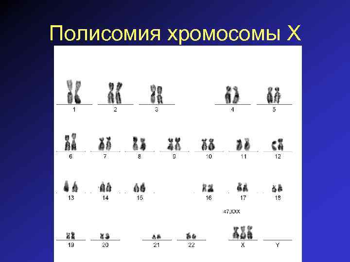 Полисомия хромосомы Х 