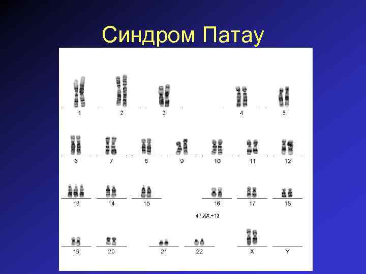 Синдром Патау 