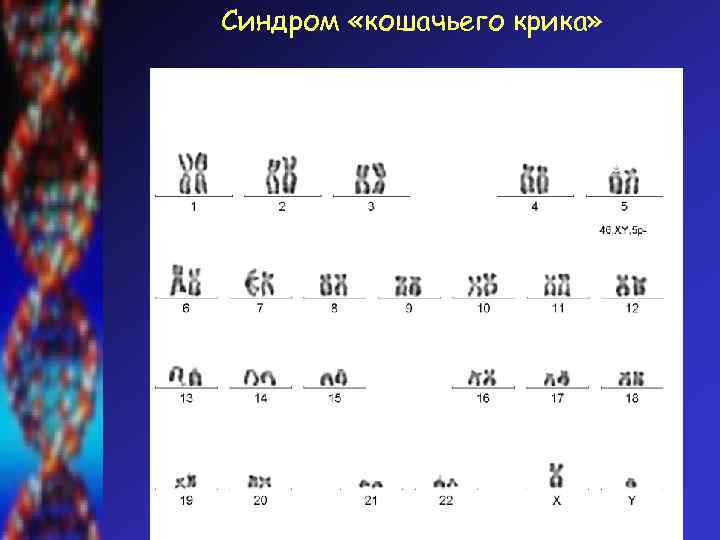 Синдром «кошачьего крика» 