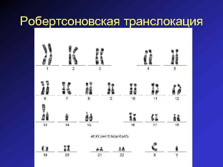 Робертсоновская транслокация 