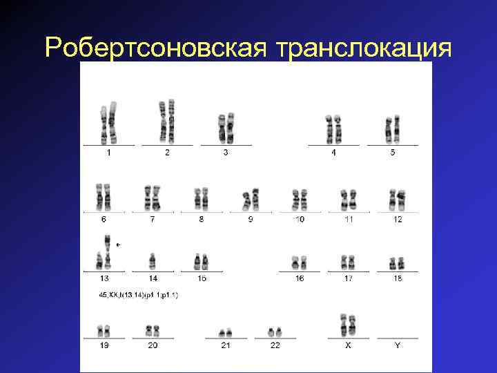 Робертсоновская транслокация 