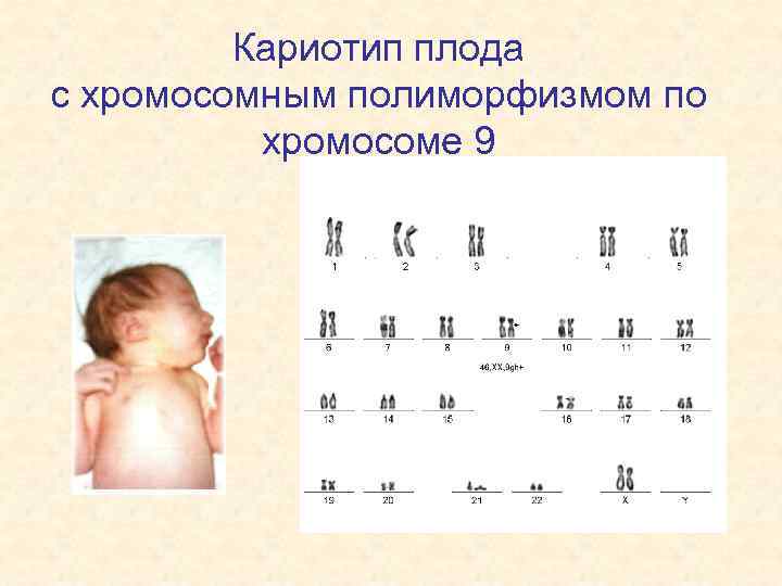 Кариотип плода с хромосомным полиморфизмом по хромосоме 9 