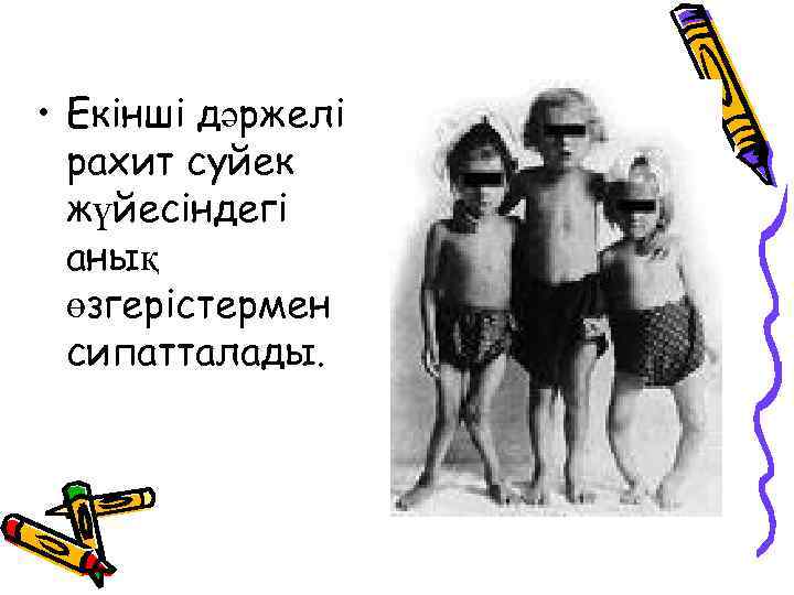  • Екінші дәржелі рахит суйек жүйесіндегі анық өзгерістермен сипатталады. 