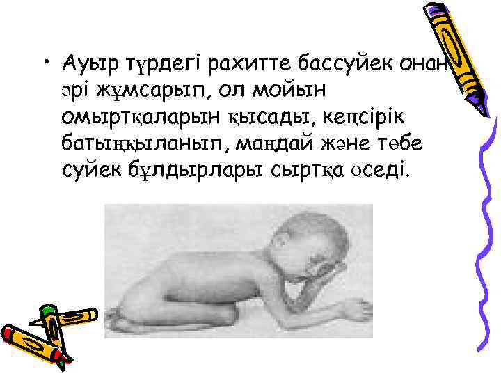  • Ауыр түрдегі рахитте бассуйек онан әрі жұмсарып, ол мойын омыртқаларын қысады, кеңсірік