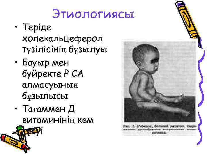 Этиологиясы • Теріде холекальцеферол түзілісінің бұзылуы • Бауыр мен буйректе Р СА алмасуының бұзылысы