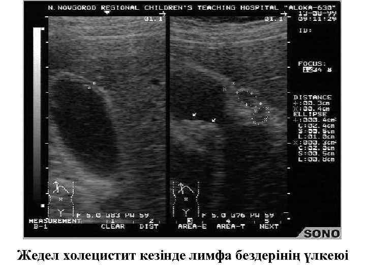 Жедел холецистит кезінде лимфа бездерінің үлкеюі 