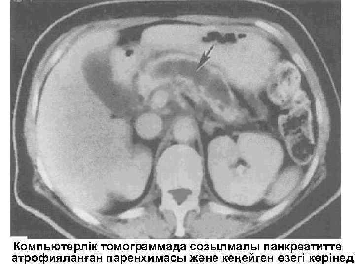 Компьютерлік томограммада созылмалы панкреатитте атрофияланған паренхимасы және кеңейген өзегі көрінеді 