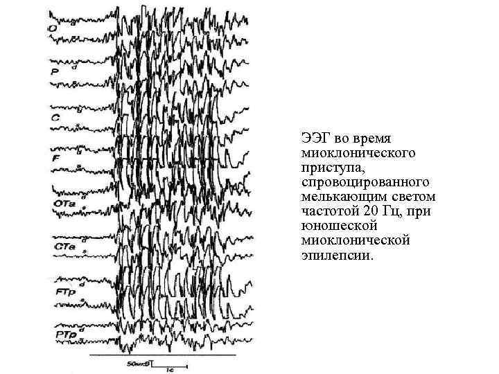 Ээг при эпилепсии фото