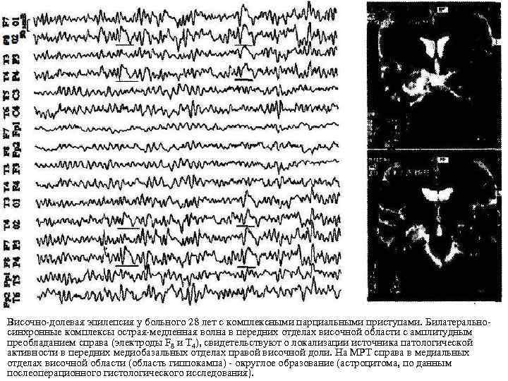 Височно-долевая эпилепсия у больного 28 лет с комплексными парциальными приступами. Билатеральносинхронные комплексы острая-медленная волна