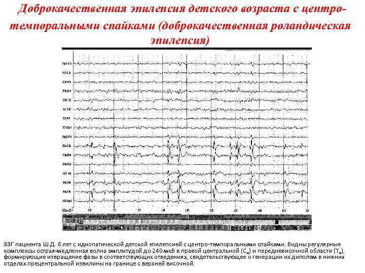 Доброкачественная эпилепсия детского возраста с центротемпоральными спайками (доброкачественная роландическая эпилепсия) ЭЭГ пациента Ш. Д.