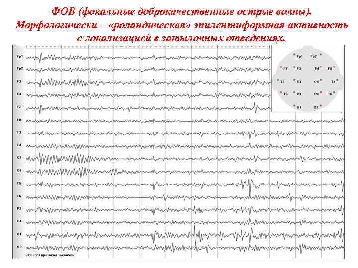 ФОВ (фокальные доброкачественные острые волны). Морфологически – «роландическая» эпилептиформная активность с локализацией в затылочных