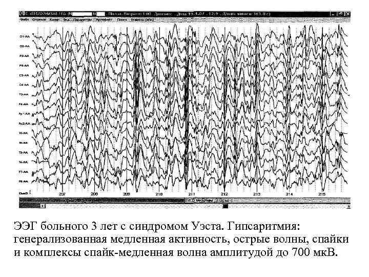 ЭЭГ больного 3 лет с синдромом Уэста. Гипсаритмия: генерализованная медленная активность, острые волны, спайки