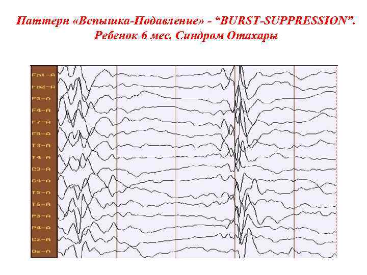 Паттерн «Вспышка-Подавление» - “BURST-SUPPRESSION”. Ребенок 6 мес. Синдром Отахары 
